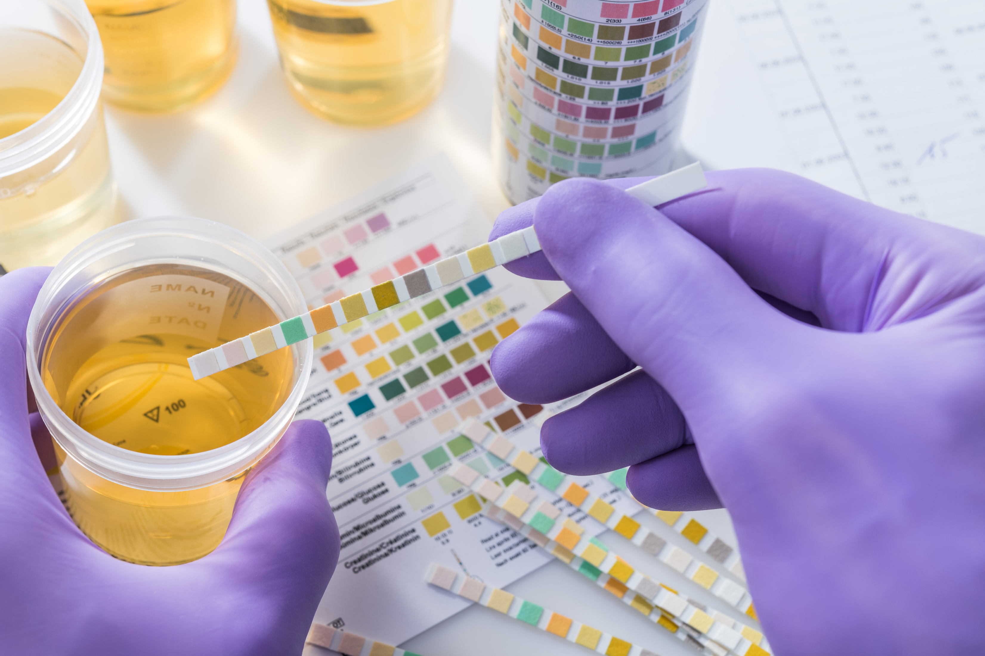 urine test strips in purple gloves